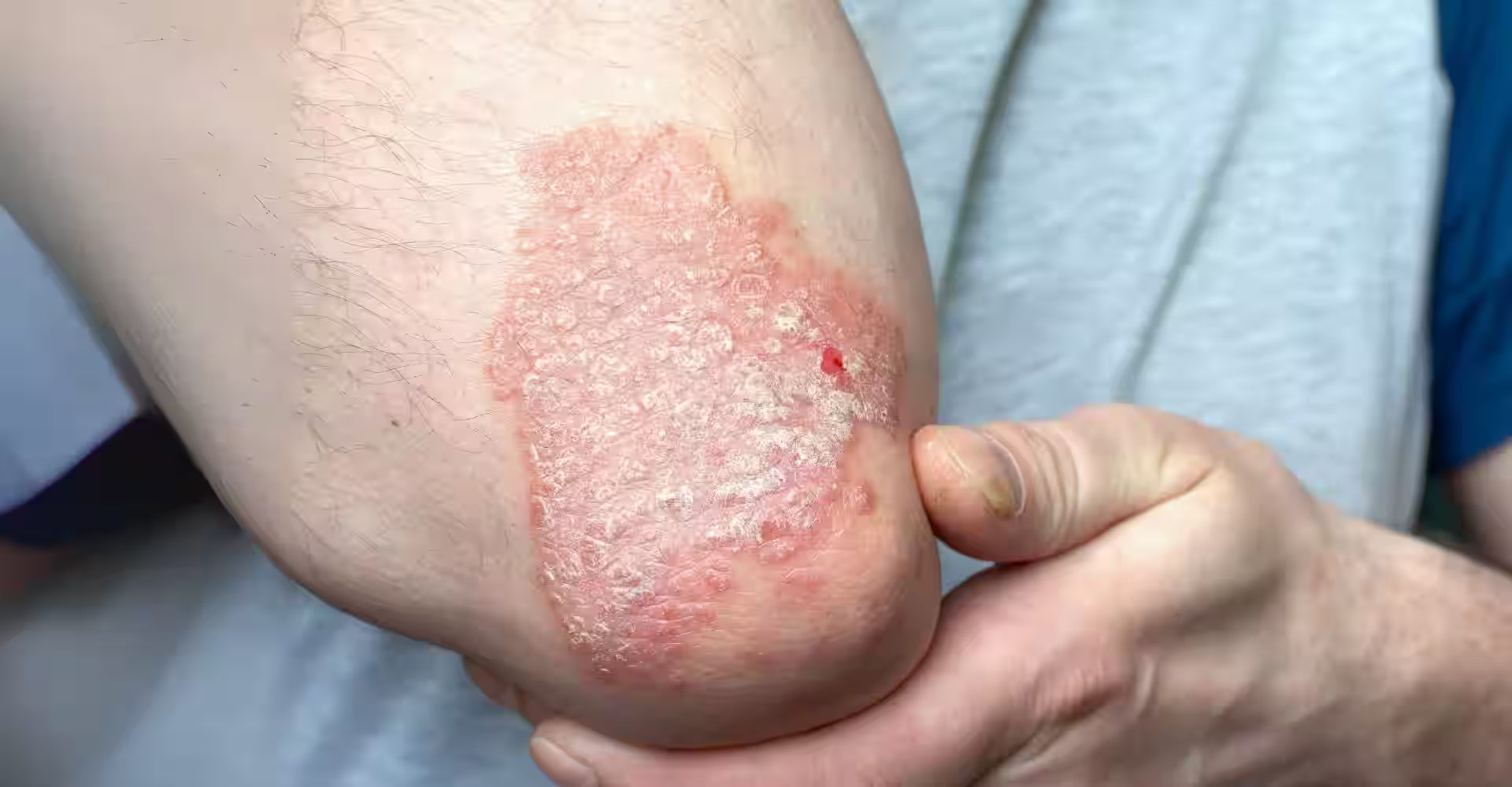 Psoriasis skin healing icon